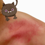 急性